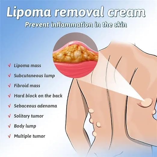Natural Lipoma Removal Cream | Free Home Delivery