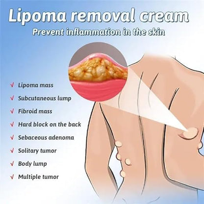 Natural Lipoma Removal Cream | Free Home Delivery